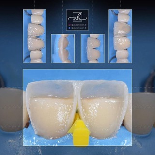 Telegram profile photo for Composite veneers
