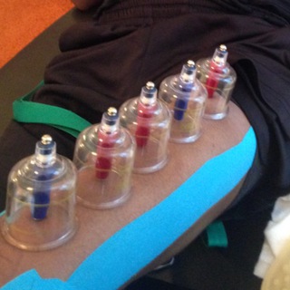 Telegram profile photo for Ottawa Cupping Therapy الحجامة والكاسات الهوائية
