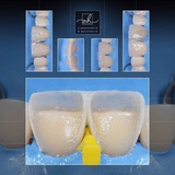 Telegram profile photo for Composite veneers