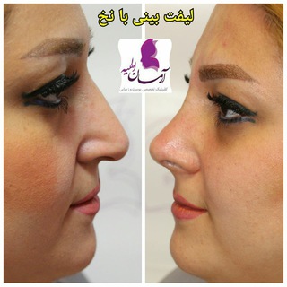 Telegram profile photo for گالری لیفت بینی با نخ