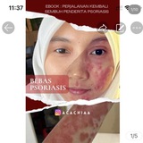 Telegram profile photo for Bebas Psoriasis & Ekzema by @Acachiaa
