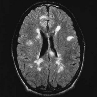 Telegram group profile photo for Multiple sclerosis | Neurology | Medicine