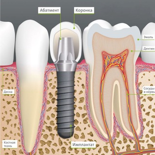 Telegram profile photo for implant and implantology