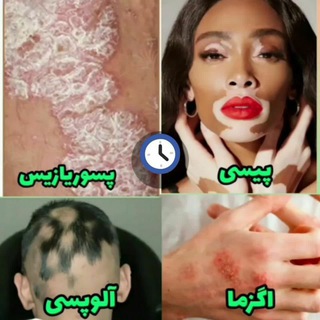 Telegram profile photo for درمان پسوریازیس و اگزما
