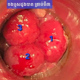 Telegram profile photo for វិធីសាស្ត្រចងឬសដូងបាត Ligation Hemorrhoide