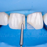 Telegram profile photo for Anterior Composite